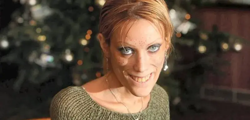 anorexieisabellecaro1.jpg